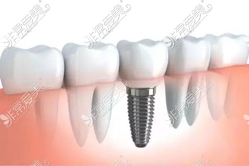 问南通种植牙多少钱一颗?从2022口腔医院种植牙价格表来说