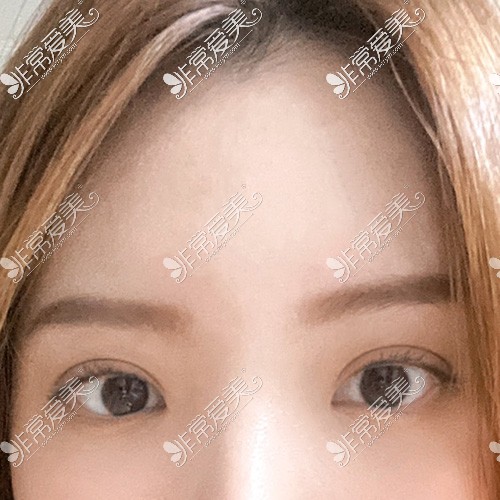 韩国yellow整形双眼皮手术图
