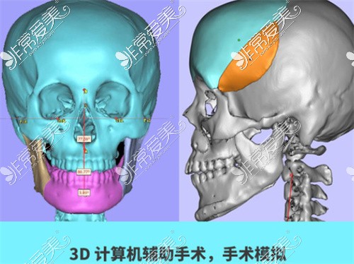 3D正颌手术示意图