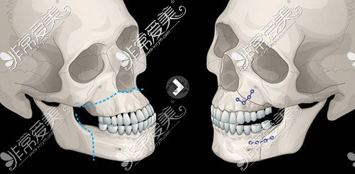 雙鄂手術(shù)示意圖