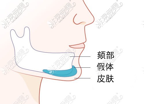 假体垫下巴