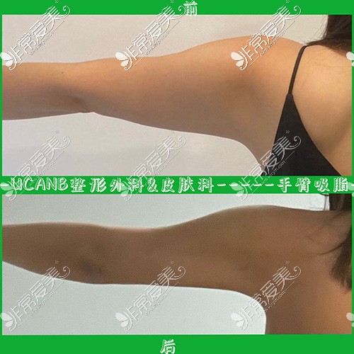 韩国Ucanb整形手臂吸脂图片