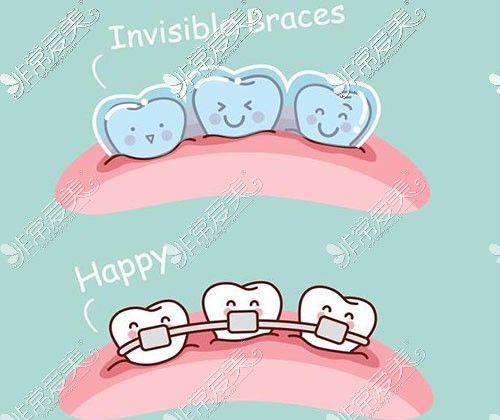 牙齿矫正图片