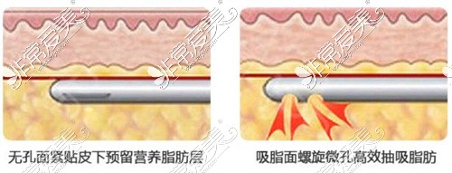 义乌阳光美容平滑吸脂示意图