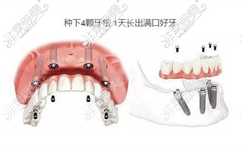 全口牙齿种植示意图