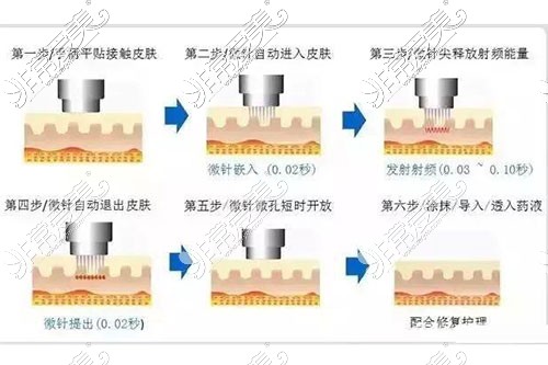 黄金微针示意图