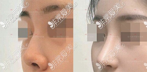 韩国现代美学隆鼻手术对比照