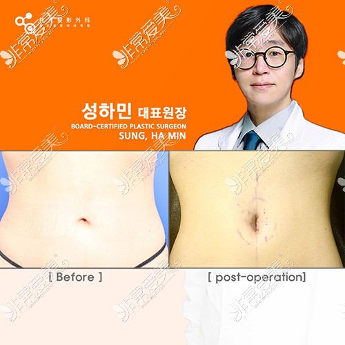 韩国林克整形肚脐手术对比照