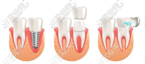 种植牙、牙冠修复、牙齿贴面