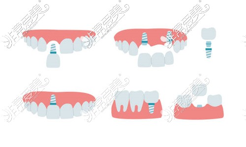 不同缺牙修復方式