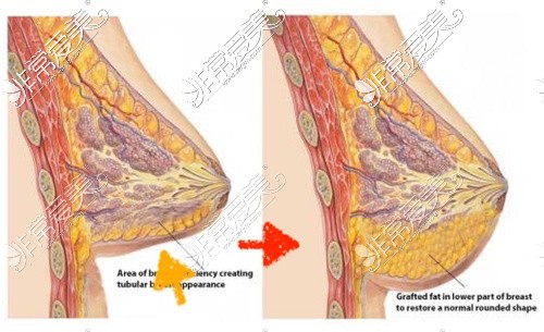 脂肪较少得到胸部移植脂肪后更饱满