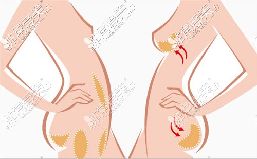常見的脂肪隆胸吸脂區(qū)域