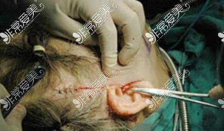 拉皮手术切口照片