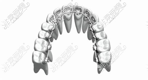 舌侧牙齿矫正设计图