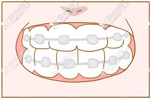 牙齿矫正漫画图