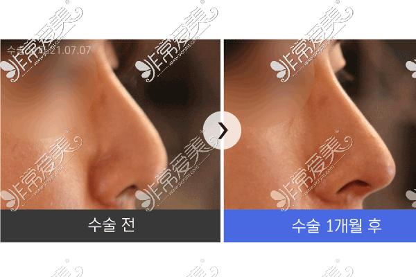 韩国清潭星隆鼻手术对比照