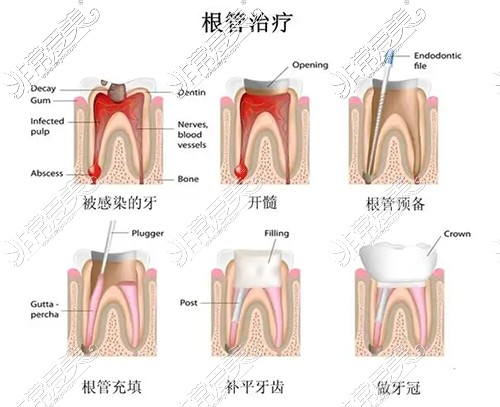 根管治療圖示