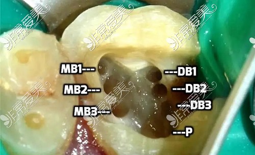 跪求泉州根管治疗多少钱?起底口碑牙科根管治疗收费标准!