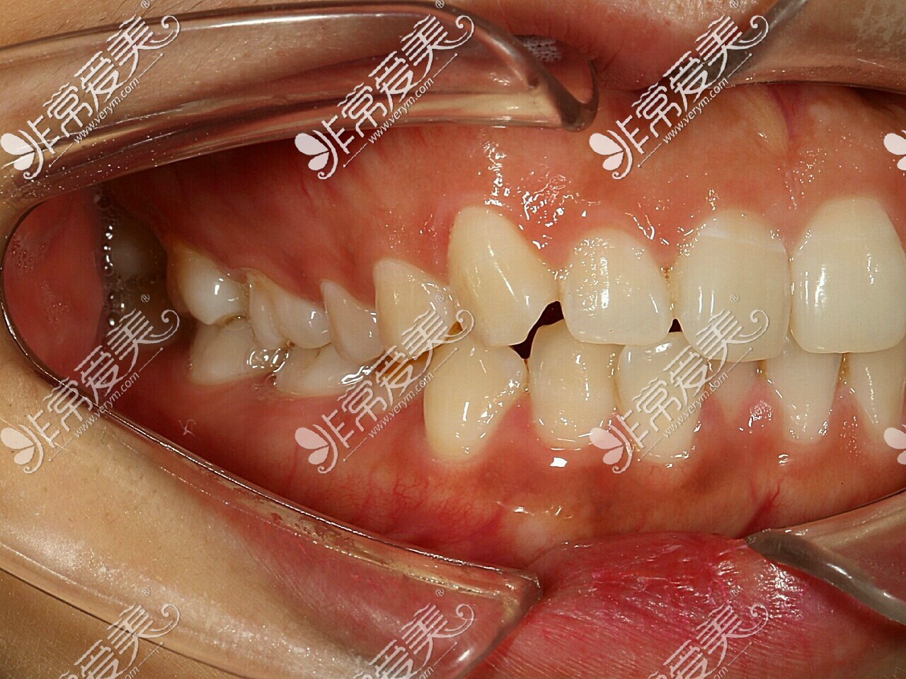 隐形牙套比钢丝牙套贵多少？牡丹江牙套价格一般多少钱？