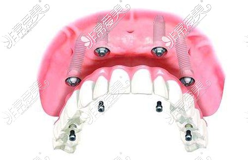 半口种植牙展示图