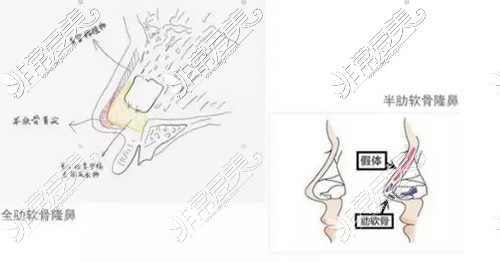 全肋隆鼻和半肋隆鼻图示