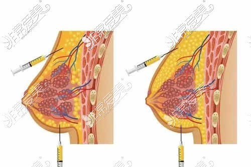 脂肪填充丰胸