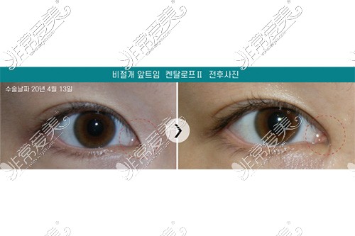 韩国清潭星整形内眼角手术对比照