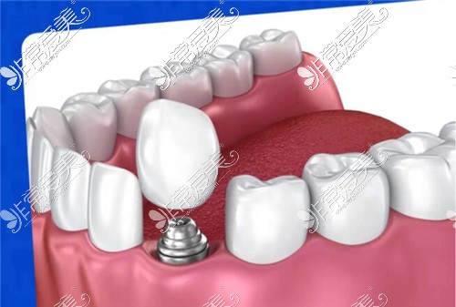 种植牙示意图