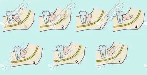 智齿的各种情况