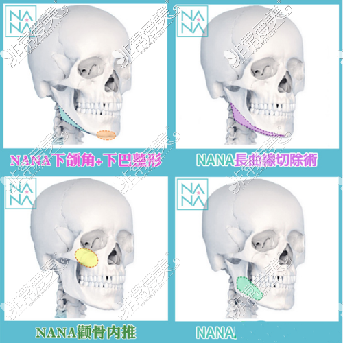 韩国NANA整形外科颌面整形