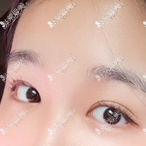韩国yellow眼整形术后30天照片