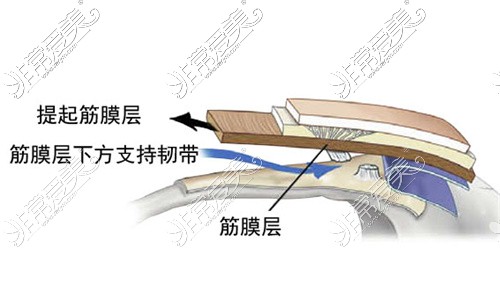 肌肉下方剥离层次