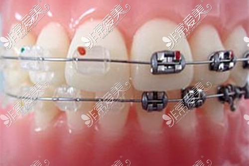 牙齿矫正常见的金属矫正和陶瓷矫正