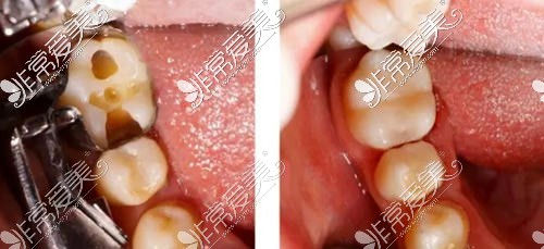 安顺补牙多少钱一颗牙？补牙300一颗贵吗？