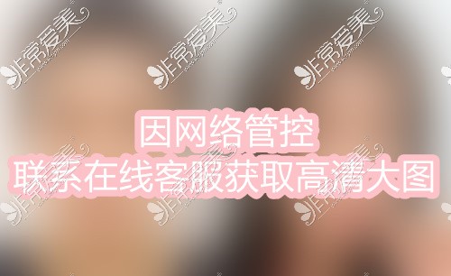 罗恩颧骨内推对比图