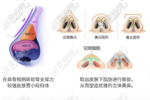 鼻整形示意图