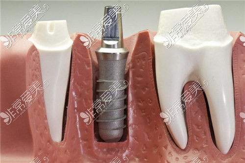 种植牙示意图