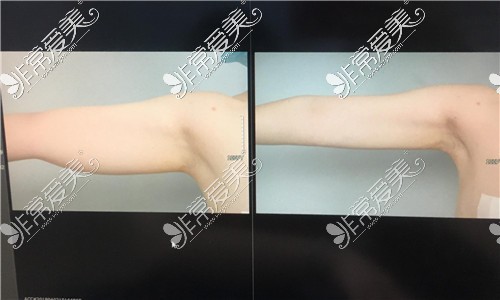 韩国365mc医院手臂吸脂修复