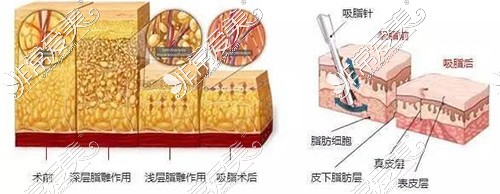 吸脂手术示意图