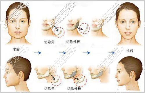 颌面轮廓过程图