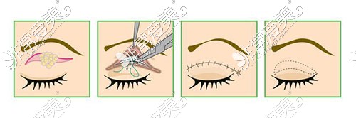 双眼皮手术示意图