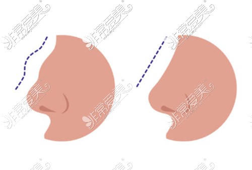 重慶百達麗醫(yī)療美容醫(yī)院隆鼻卡通