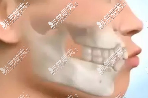 常见凸嘴的几种类型！骨性凸嘴问题