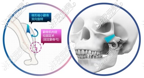 颧骨整形手术卡通图