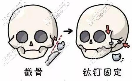 颧骨整形改善治疗卡通图展示