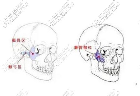 颧弓颧骨改善治疗展示图