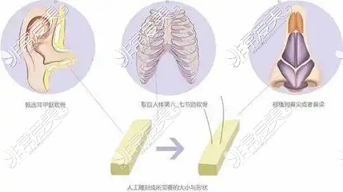 耳軟骨和肋軟骨隆鼻圖示