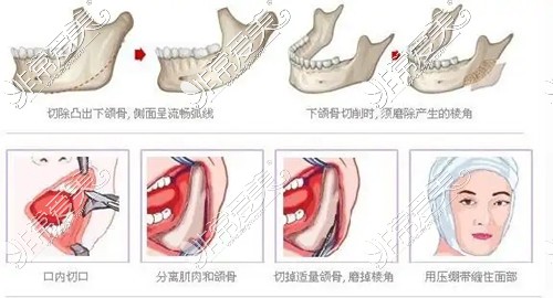 贵阳下颌角手术+颧骨手术就选这家整形医院,技术好医生靠谱