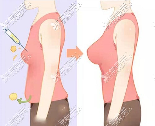 脂肪隆胸前后对比图