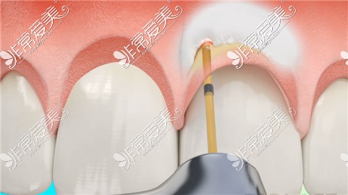 水激光治疗牙龈